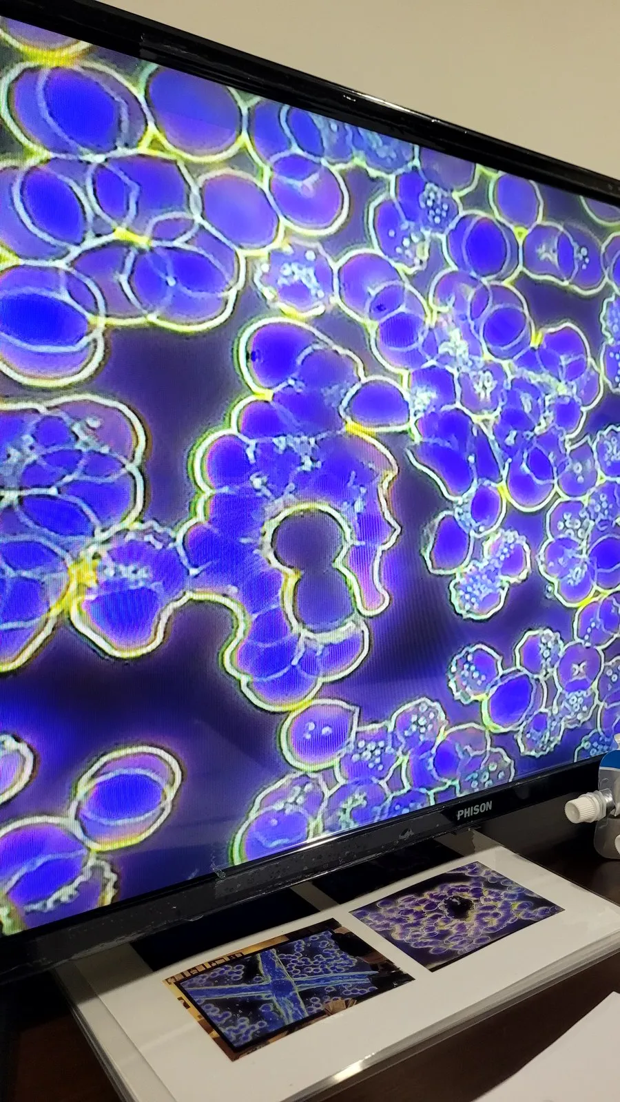 My blood cells on a screen under the microscope